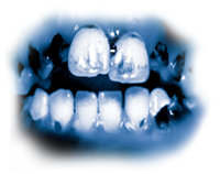 甲安中的有毒成分會造成嚴重齲齒，也就是大家所知的「甲安嘴」。一個人的牙齒會變黑、有污漬、損壞，往往最後必須拔掉。牙齒和牙齦從內部毀壞，牙根也腐爛掉。